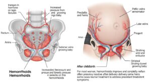 Do Pregnancy Hemorrhoids Go Away Permanently After Delivery?